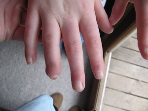 Gezwollen vingers van Isabel