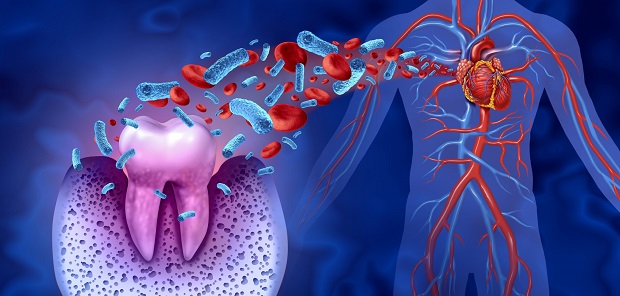 Ontstoken tandvlees kan leiden tot beroertes
