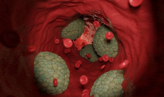 ‘Slecht’ LDL-cholesterol verlaagt kans op kanker