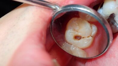 Beginnend gaatje herstellen zonder tandarts