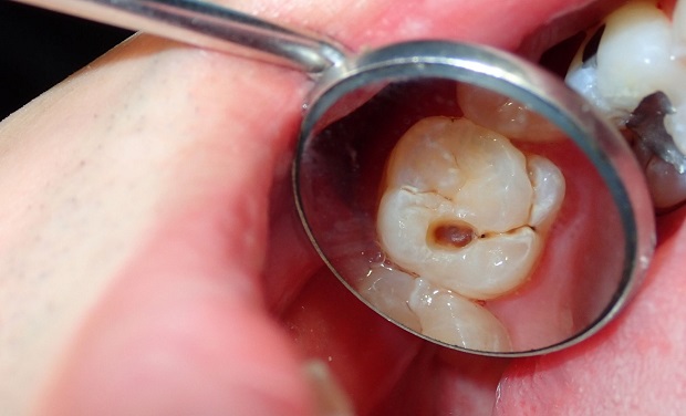 Beginnend gaatje herstellen zonder tandarts