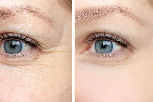 Er jonger uitzien zonder botox of crèmes?