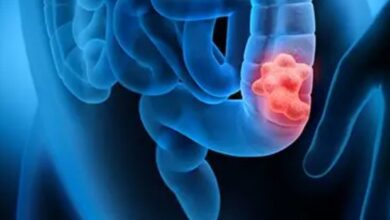 10 vroege signalen van darmkanker die je nooit mag negeren