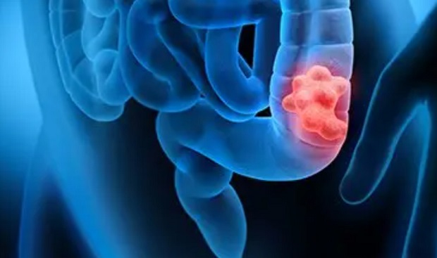 10 vroege signalen van darmkanker die je nooit mag negeren