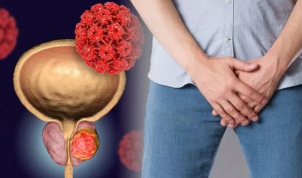 Vergrote prostaat natuurlijk verkleinen