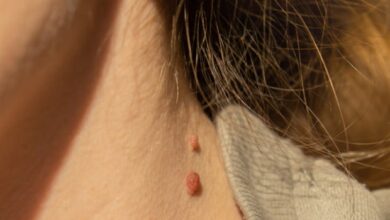 Steelwratjes en wratten natuurlijk verwijderen binnen 24 uur