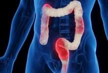De snelste thuis-test voor darmklachten zoals Crohn, PDS, coeliakie en colitis ulcerosa