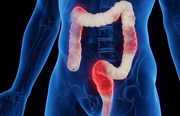 De snelste thuis-test voor darmklachten zoals Crohn, PDS, coeliakie en colitis ulcerosa